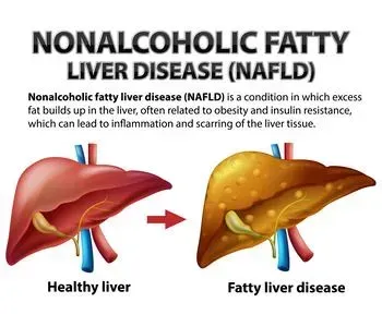 non alcoholic fatty liver disease